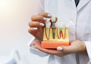 Full Dental Implant cost in Bangalore