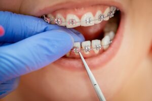 Orthodontic treatment