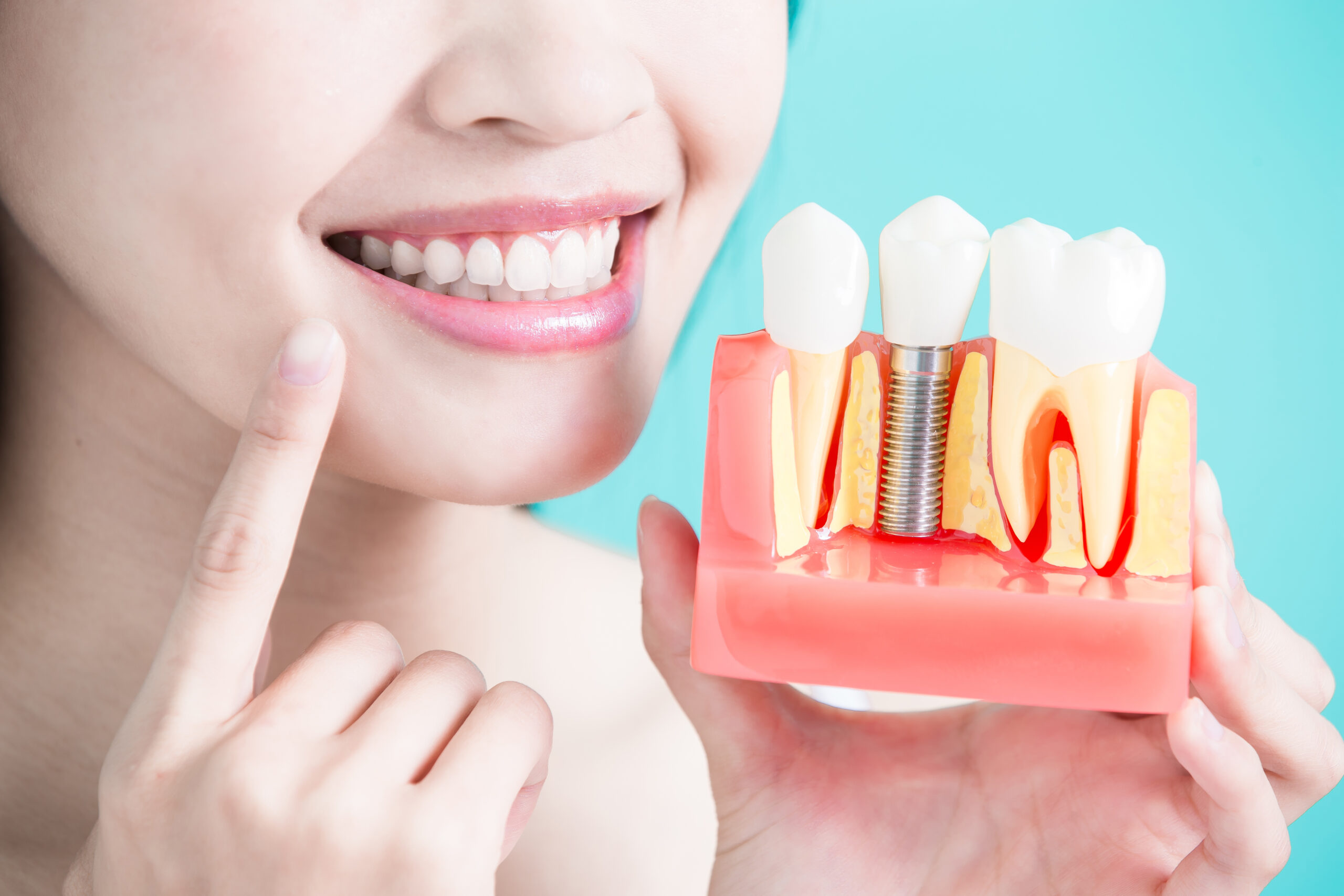 The Role of Dental Implants in Periodontal Rehabilitation