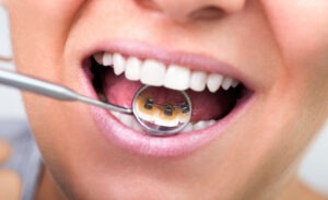 lingual braces in Bangalore