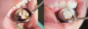 tooth cavity filling