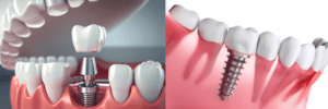best dental implant clinic in Bangalore