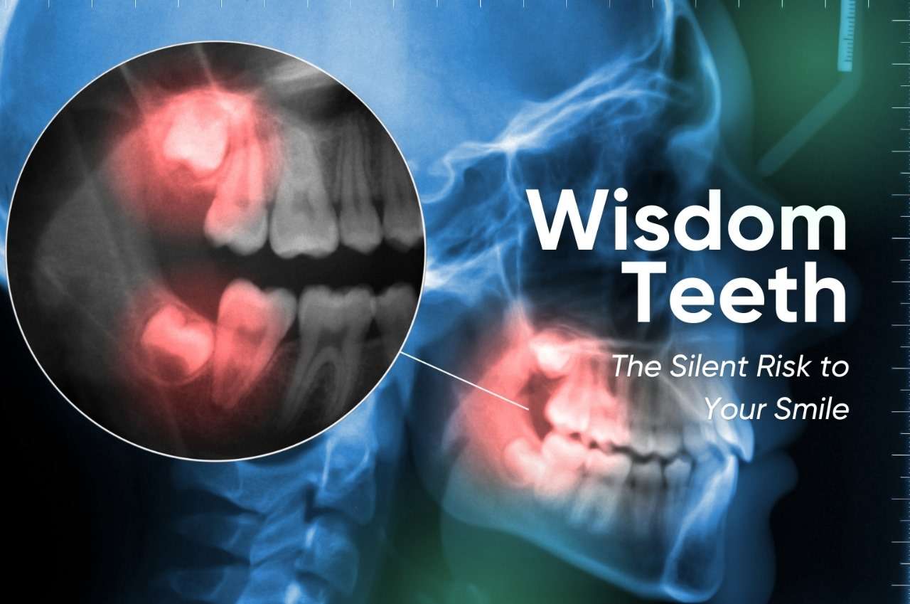 Wisdom Teeth: The Silent Risk to Your Smile