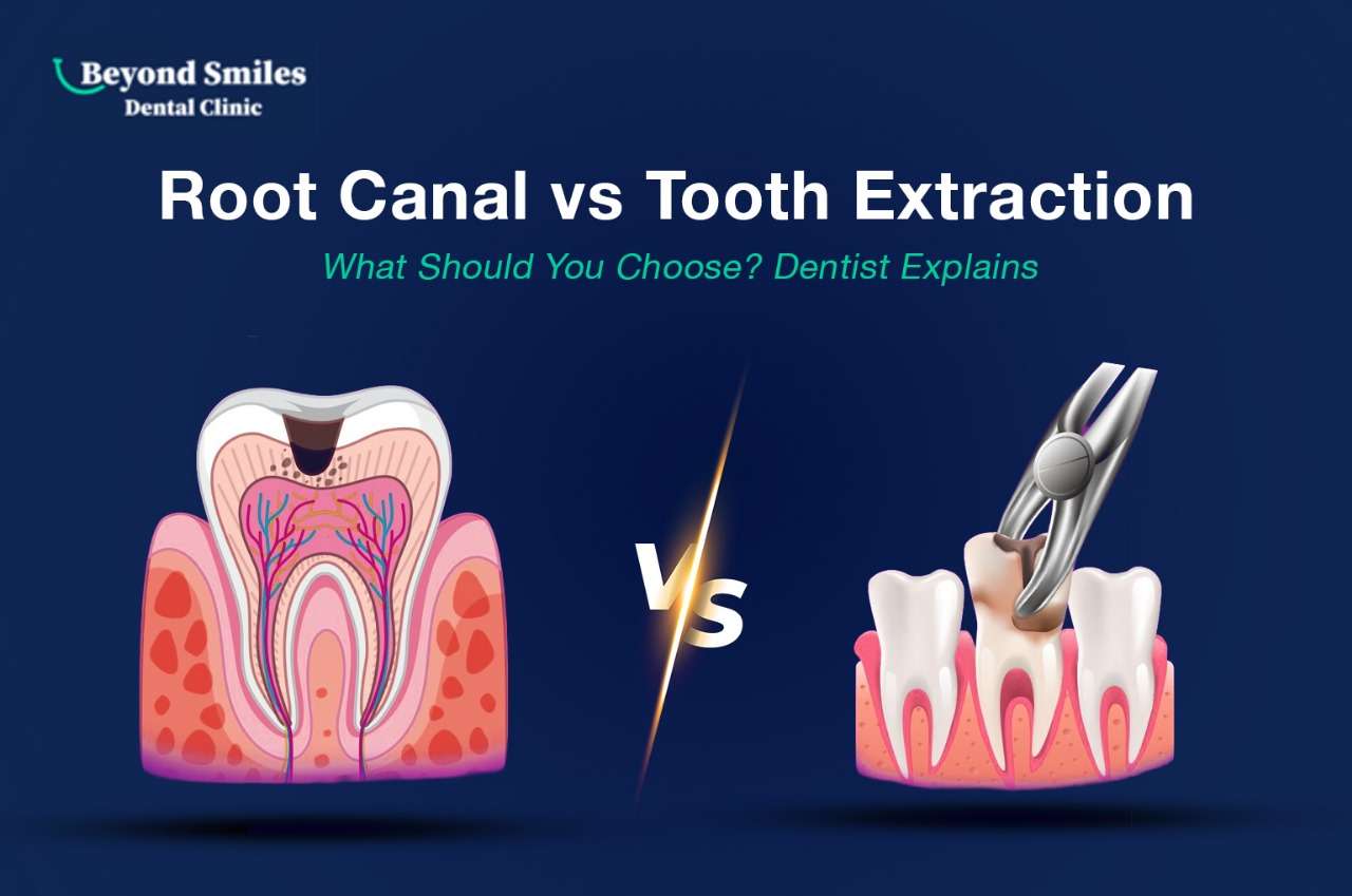 Root Canal vs Tooth Extraction – What Should You Choose? Dentist Explains 