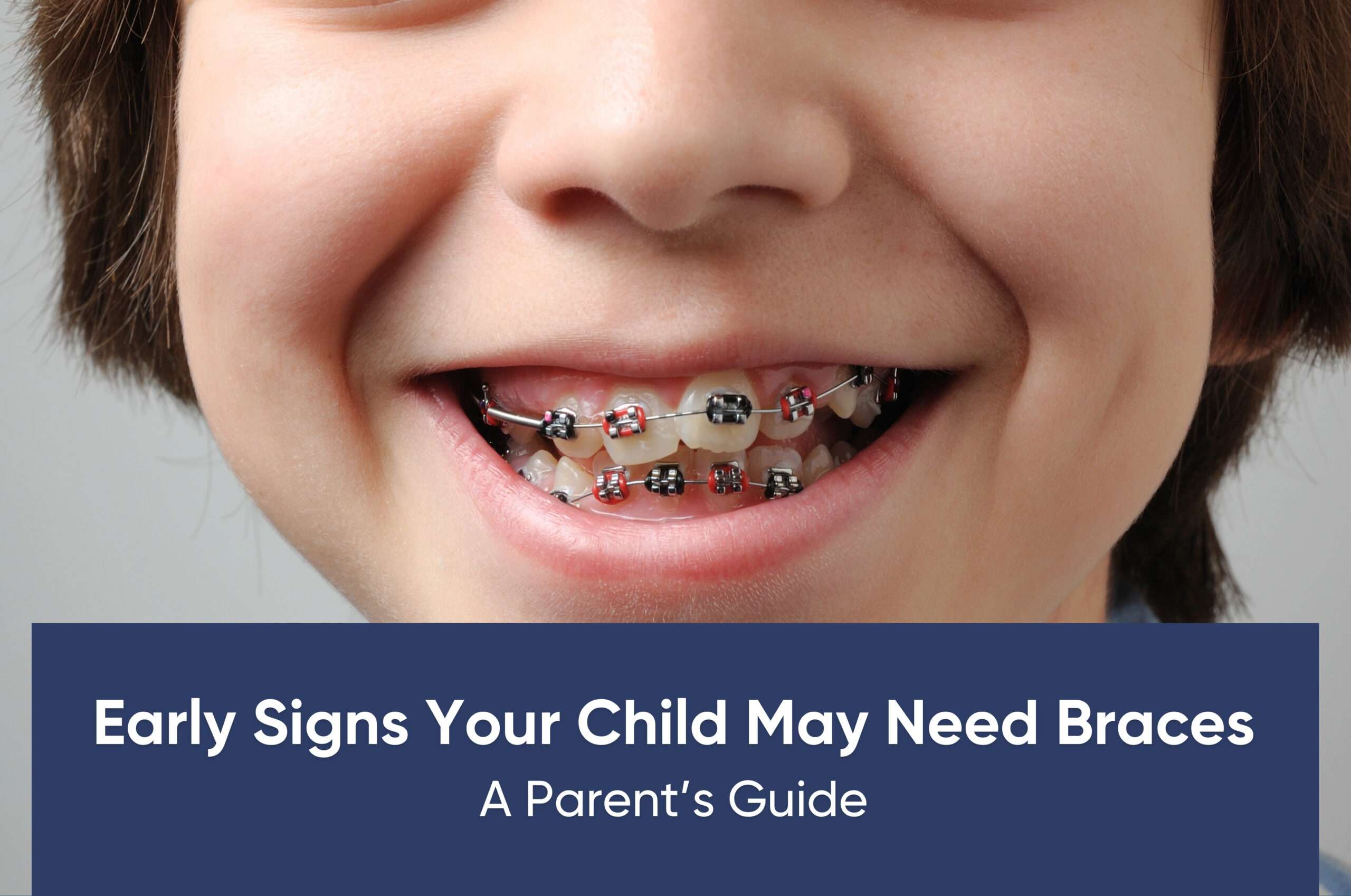 Early Signs Your Child May Need Braces: A Parent’s Guide
