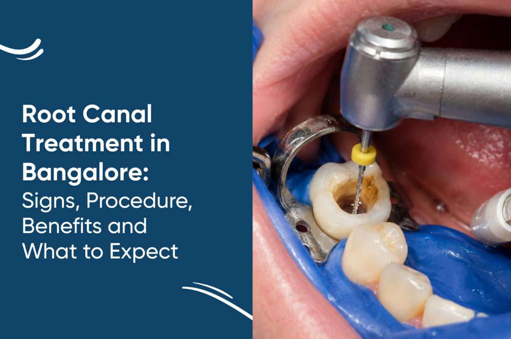 Root Canal Treatment in Bangalore: Signs, Procedure, Benefits and What to Expect