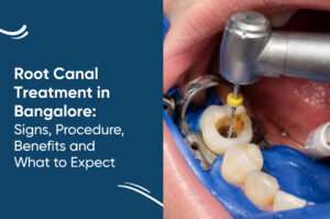 Root Canal Treatment in Bangalore: Signs, Procedure, Benefits and What to Expect