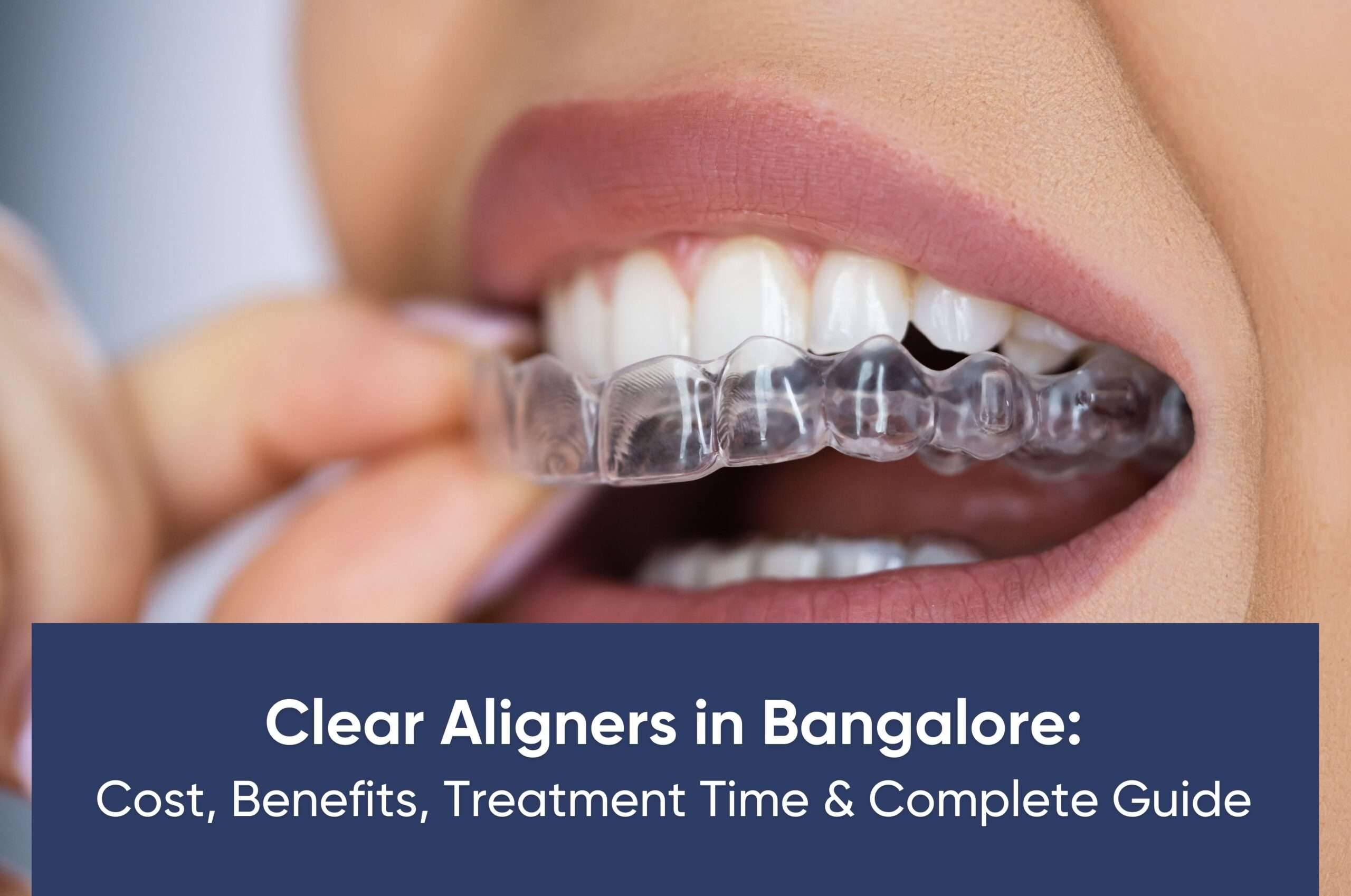 Clear Aligners in Bangalore: Cost, Benefits, Treatment Time & Complete Guide