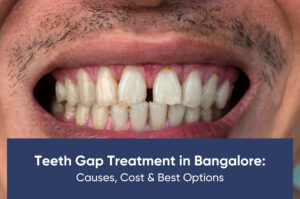 Teeth Gap Treatment in Bangalore: Causes, Cost & Best Options